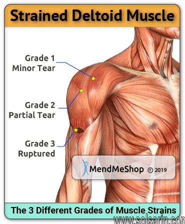 deltoid muscle pain tendonitis