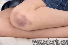 bruise is to fall as bump is to