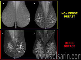 heterogeneously dense breast tissue