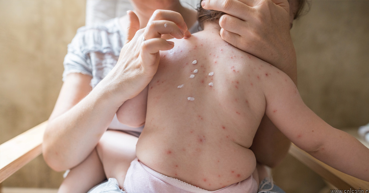 how did chickenpox get its name?