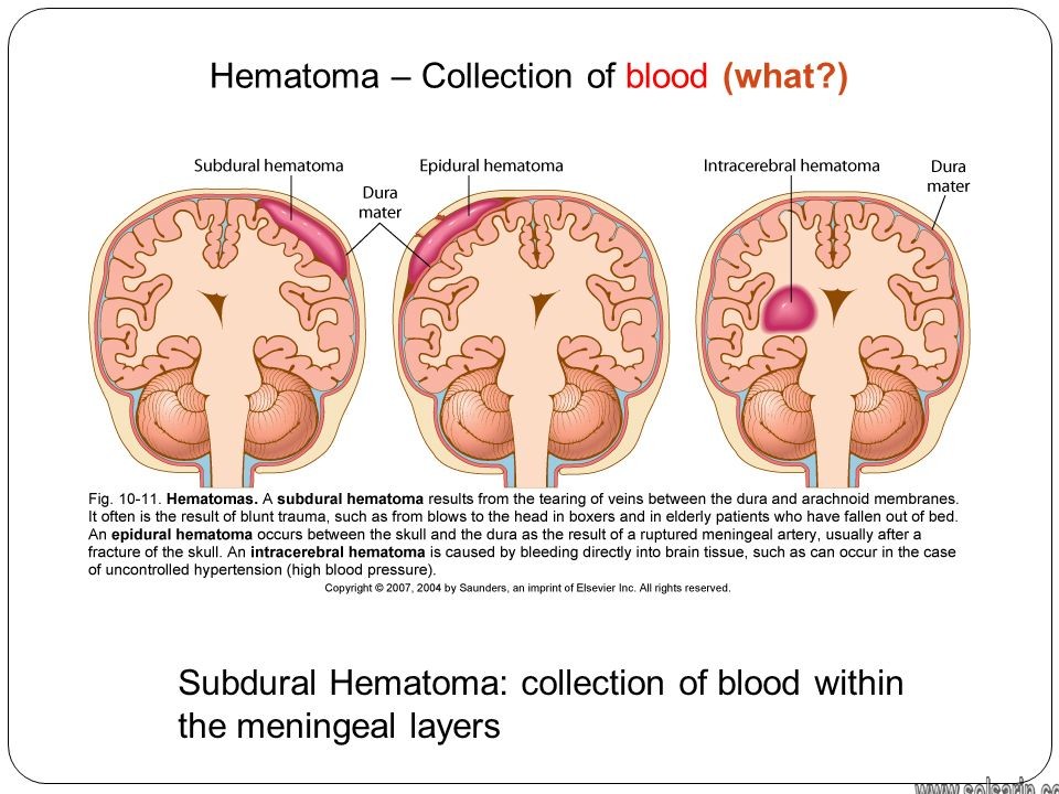 collection of blood within the meningeal layers