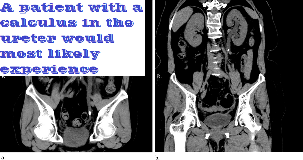 A patient with a calculus in the ureter would most likely experience