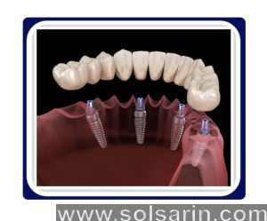 clear choice dental implants cost